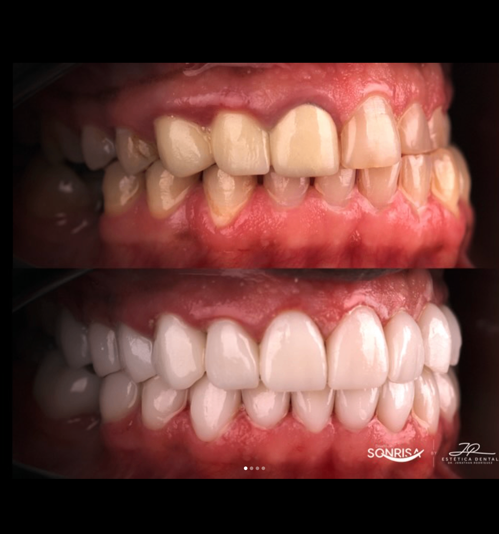 Side profile before and after dental rehabilitation