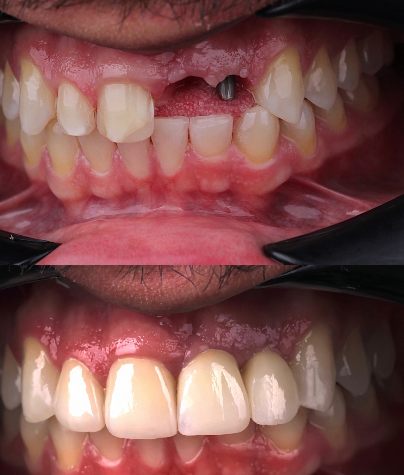 Implant transformation before and after case
