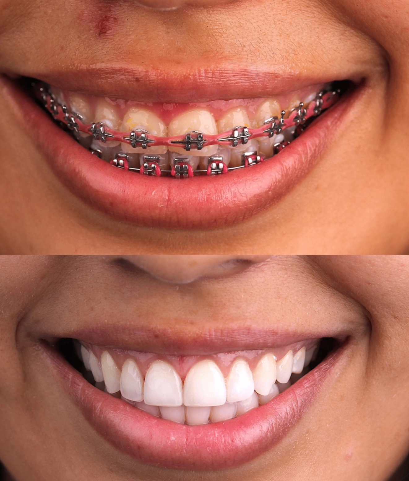 Before and after smile transformation