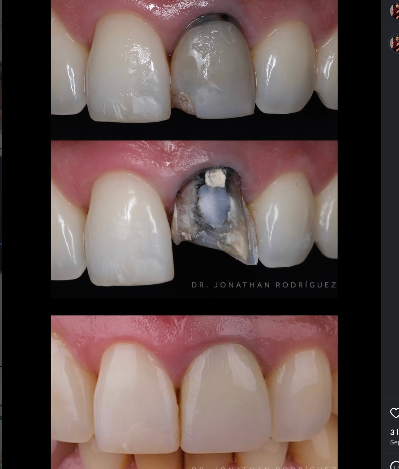 Restorative dental detail before and after
