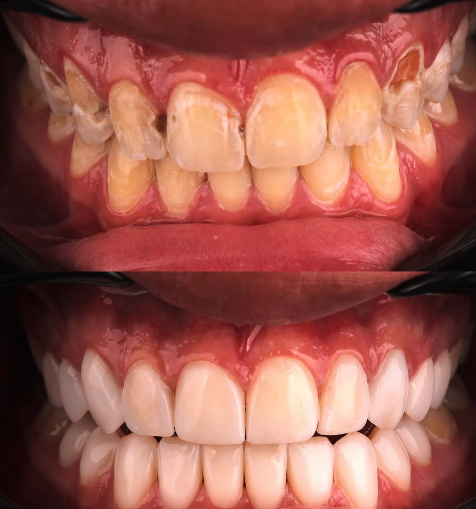 Before and after full smile rehabilitation case