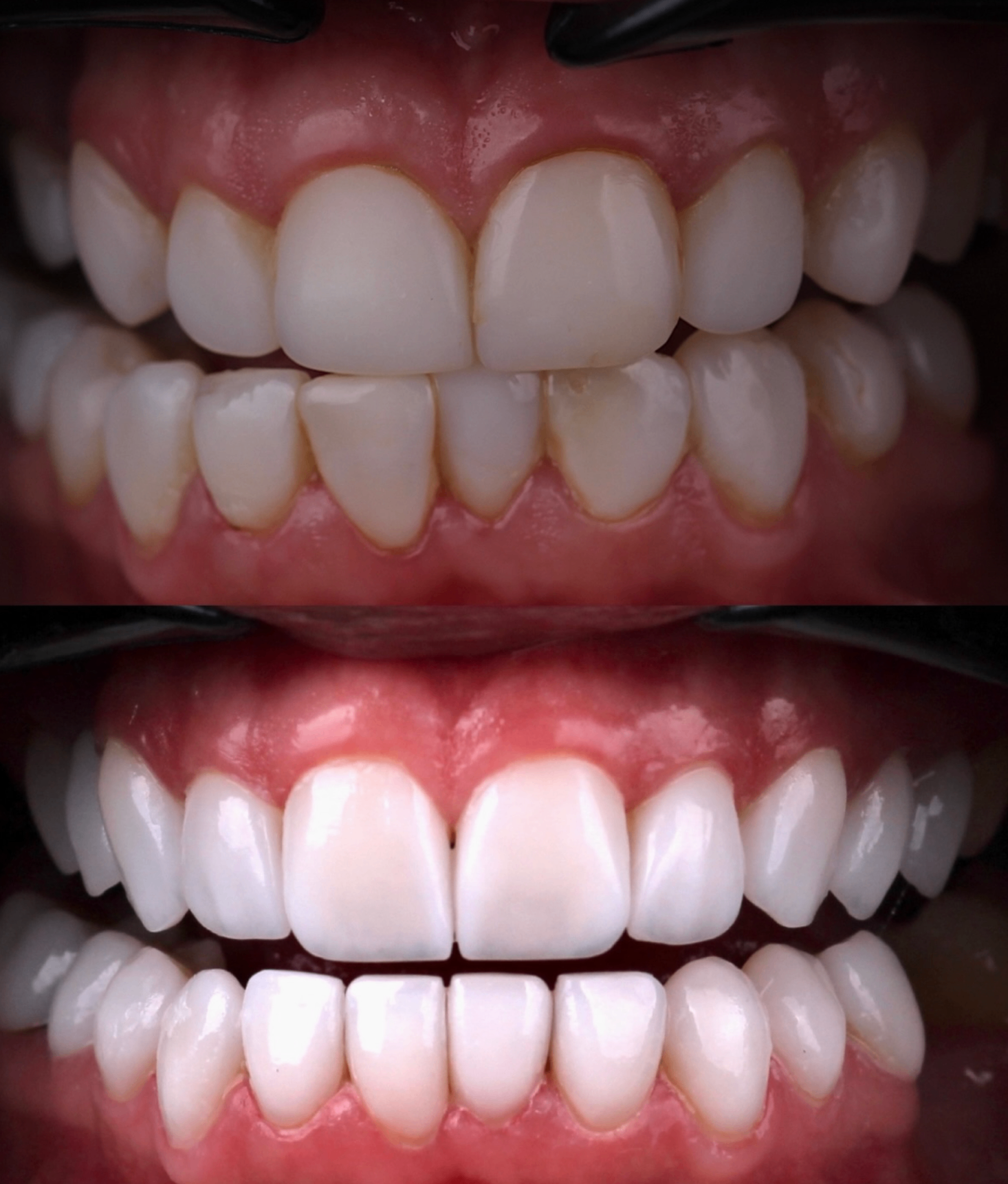 Before and after bite and smile rehabilitation