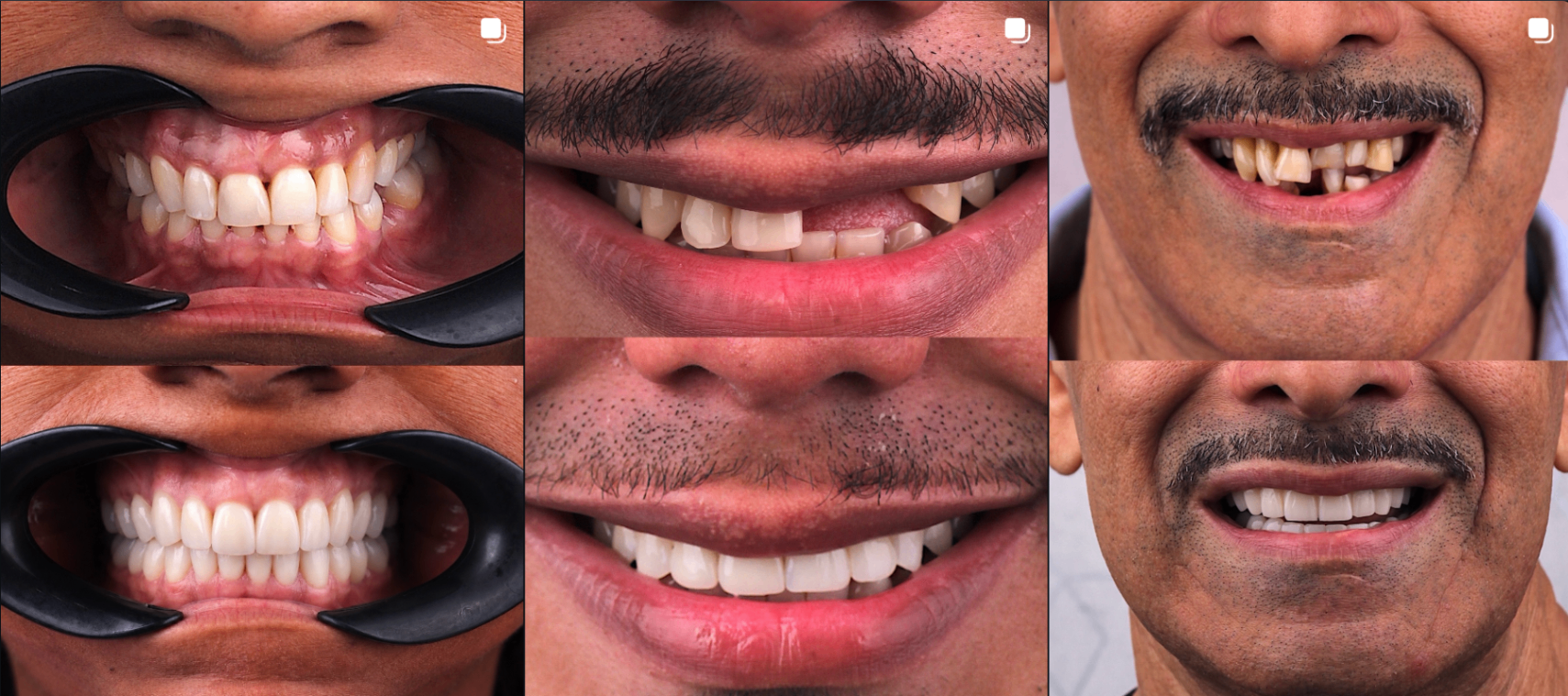Grid of before and after smile transformation cases